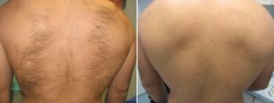 Шугаринг фото до и после эпиляции спины