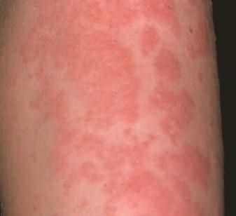 Фото аллергической реакции на коже