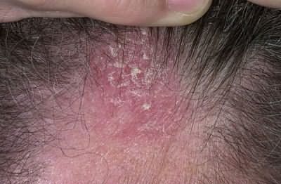 Последствия вторичного инфицирования через открытые язвочки: фото участка, пораженного себорейным дерматитом
