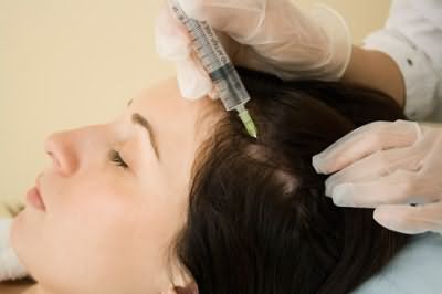 Процедура мезотерапии при лечении выпадения волос